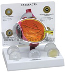 Cataract Eye Model